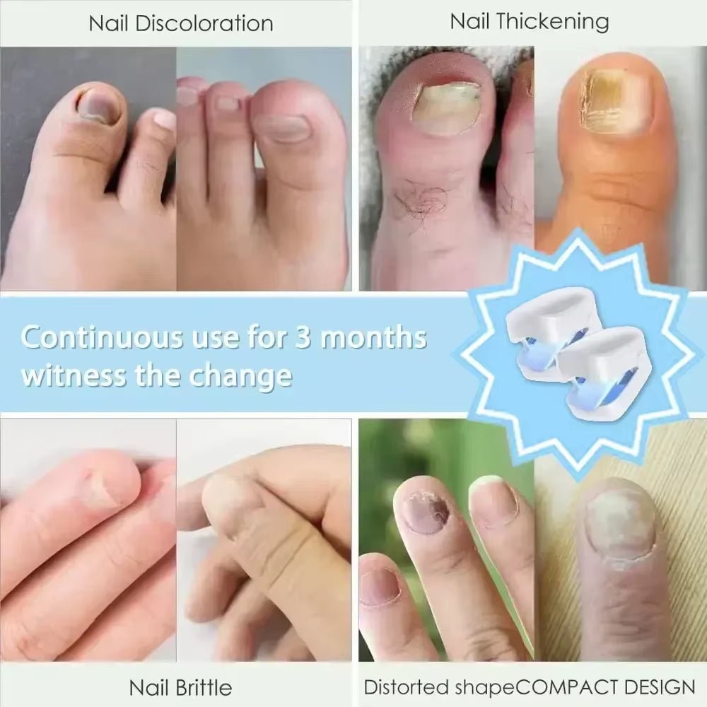 Nail Fungus Laser Treatment Device Repair Toenail Fingernail Fungus Treat Onychomycosis Therapy Cure Machine Effectively Remove - Bavaro Shop